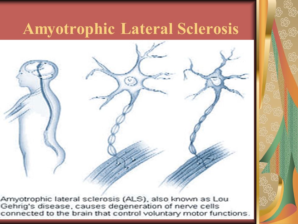 Amyotrophic lateral sclerosis: Brief Note Book